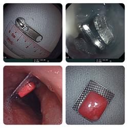 Đắk Lắk: Cháu bé 6 tuổi nuốt đầu khóa kéo của hộp bút vào dạ dày