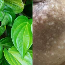 Đắp "thần dược" trị nám, mặt người phụ nữ trẻ xám xịt, loang lổ