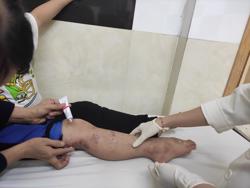 Tự điều trị chốc, nhiều trẻ bị lở loét khắp người