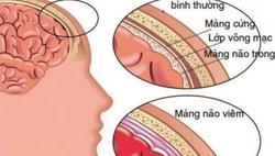 Cảnh giác với bệnh viêm màng não