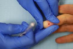 Xét nghiệm thấy điều này, cẩn thận đột quỵ trước 60 tuổi