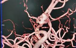 Đừng để "ngã ngựa" do tăng huyết áp