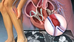 Tắc động mạch chi dưới vì hút thuốc lá