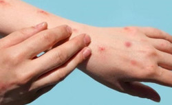 TP HCM: Ghi nhận ca tử vong đầu tiên liên quan đến bệnh đậu mùa khỉ