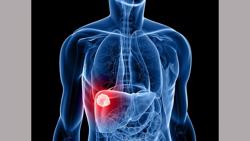 6 dấu hiệu cảnh báo ung thư gan nhiều người bỏ sót