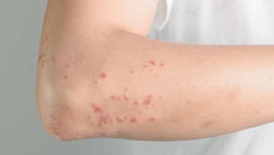 Nguy cơ dị ứng nặng khi sử dụng thuốc nam