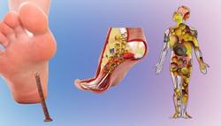 Cảnh giác trước nguy cơ tử vong vì bệnh uốn ván