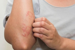 Đề phòng viêm da cơ địa khi giao mùa