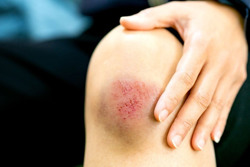 Không chủ quan với vết thương ngoài da