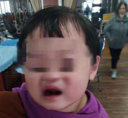Bé 2 tuổi méo miệng, liệt dây thần kinh số 7 do trời lạnh