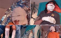 Điện thoại sạc qua đêm phát nổ khiến hai người bỏng nặng