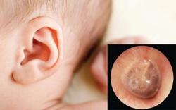 Làm thế nào trị dứt bệnh viêm tai giữa?