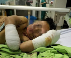 Vật thể "lạ" phát nổ, bé 8 tuổi bị cụt 2 bàn tay