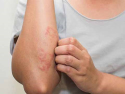 Thay đổi thời tiết liên tục: Không chủ quan với viêm da cơ địa