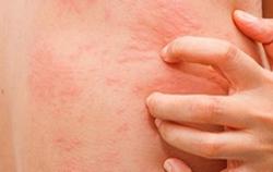 Vì sao bệnh ngoài da tăng mạnh do nồm ẩm?