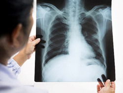 Bệnh nhân ung thư phổi ngày càng trẻ hóa