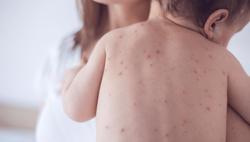 Phòng bệnh truyền nhiễm ở trẻ nhỏ