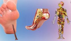 Không lơ là với nhiễm trùng uốn ván