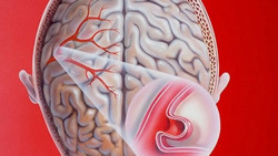 Phình động mạch não có thể biến chứng gây tử vong