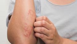 Các bệnh ngoài da phát triển mạnh vào mùa nắng, oi bức