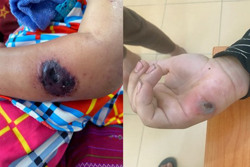 Phòng tránh sự nguy hiểm của bệnh than ra sao?