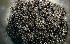 Người phụ nữ "tích" hàng ngàn viên sỏi mật trong cơ thể