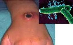 Bộ Y tế thông tin về tình hình dịch bệnh than trên người