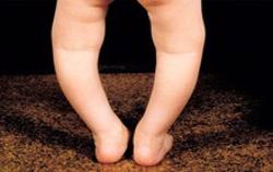 Làm sao nhận biết chân con bị vòng kiềng?