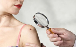 Cẩn thận khi nốt ruồi có dấu hiệu lạ