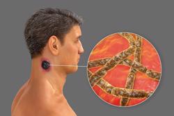 Bệnh than có điều trị được không?