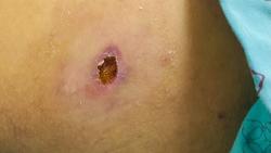 Nguy cơ sốt mò gia tăng trở lại