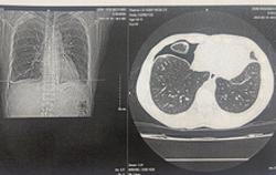 Sán bám chặt hai lá phổi sau khi ăn gỏi cua sống