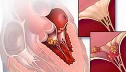 Nguy cơ trẻ mắc viêm cơ tim