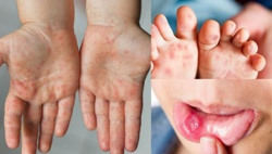 Gần 70.000 ca mắc tay chân miệng