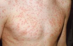 Nguy cơ nhiễm trùng huyết ở trẻ em