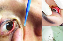 Bác sĩ nói gì về dịch vụ “bắt sâu mắt" đang nở rộ?