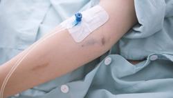 Nguy hiểm khi truyền dịch tại nhà