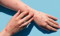 2 ca mắc đậu mùa khỉ, Bộ Y tế đề nghị xác định nguồn lây