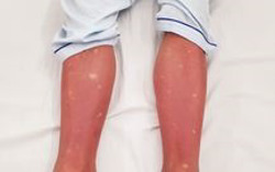 Nên xét nghiệm sốt xuất huyết ở ngày thứ mấy?