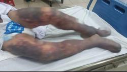 Người đàn ông khoẻ mạnh bất ngờ nguy kịch sau ăn "món khoái khẩu"