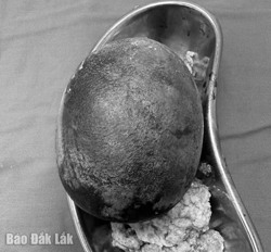 Phẫu thuật lấy viên sỏi nặng 700g khỏi cơ thể bệnh nhân