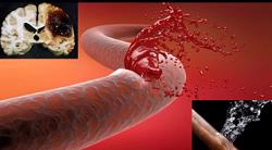 Thời tiết chuyển mùa, PGS-BS Nguyễn Huy Thắng khuyến cáo đột quỵ