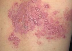 Đau do zona thần kinh có thể kéo dài nhiều tháng