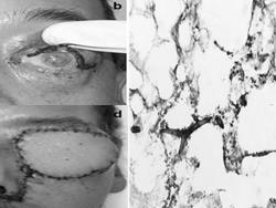 Gia tăng bệnh nấm đen mới nổi sau COVID-19