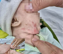 Bé 2 tháng tuổi mắc giang mai từ mẹ