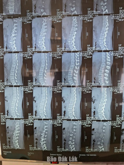 Thu hoạch hồ tiêu gặp tai nạn gãy cột sống