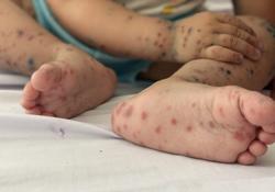 Dịch tay chân miệng ‘trở lại’: Tăng cường nhận biết dấu hiệu