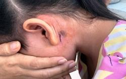 Một tài xế mắc bệnh vi khuẩn "ăn thịt người"