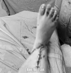 Phẫu thuật nối liền bàn chân bị đứt rời cho bệnh nhân bị tai nạn giao thông