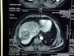 Nghiện ăn rau sống, người đàn ông bị sán lá gan bám chặt